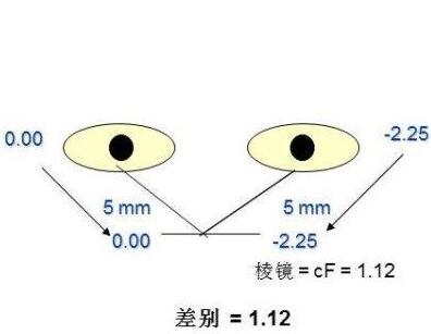 屈光参差