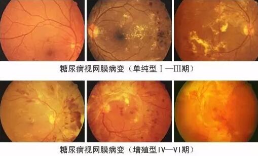 糖尿病引起的眼部并发症有很多，糖尿病视网膜病变(DR)就是其中之一，糖尿病视网膜病变是糖尿病在眼部的一种严重并发症，它对视力有很大危害，如不及时医治，可能造成失明。症状包括视力模糊、阴影、斑点及疼痛。.jpg