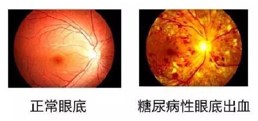  数据表明：糖尿病视网膜病变(简称糖网病)患病率达44%~51.3%，被世界卫生组织认为是仅次于白内障、青光眼的 三致盲眼病。但是不少尤其是基层糖尿病患者，大多数把眼睛的异变误认为是老年人眼花正常现象，从而耽误了病情甚至导致失明。.jpg