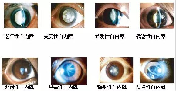 长时间在白色光亮污染环境下工作和生活的人，尤其是长时间接触过强的光线，视网膜和虹膜都会受到程度不同的损害，较终也会伤害晶状体，时间一长，就会使视力下降，使晶状体蛋白发生变性，形成混浊，发展成为白内障1.jpg