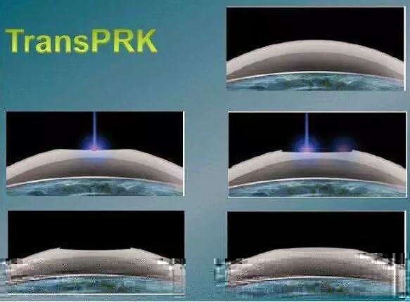 全激光TransPRK手术有其无可比拟的优势，但是 一的缺点就是属于表层手术，术后三天需要配戴隐形眼镜等待上皮愈合，在术后当天以及术后早期眼部会有较飞秒较重的不适感， 时间稍慢，一般需要一周到十天才能逐渐 .jpg