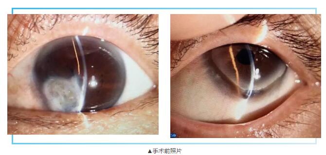 即便天气如此恶劣，合肥名人眼科医院的所有医护人员依然兢兢业业的守护在自己的岗位上。其中有两位患者分别来自安徽的蒙城和涡阳，一 角膜愈着性白斑，致虹膜前后黏连，视力仅有手动。另一 角膜严重边缘变性致穿孔，急需通过角膜移植手术保住眼球。2.jpg