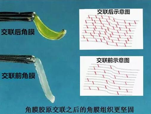 角膜胶原交联(Corneal Cross Linking，CCL)医治：使用370纳米波长的紫外线，激活核黄素(一种光敏感剂)，使其转化成活性氧族，活性氧族再诱导角膜胶原纤维的氨基之间发生化学交联反应，使角膜胶原纤维直径增粗、提*角膜基质对多种降解酶作用的抵抗力等多重生物学效应，从而使角膜基质的机械强度增加2.jpg