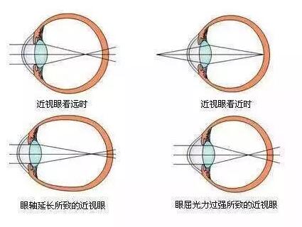 “小孩视力以前挺好的，没想到一个寒假下来就近视了。”昨天的8868在线官网登录平台 - 8868网页版登录小儿眼科门诊里，很多家长都反应说，“孩子期末成绩不错，所以假期里对他的管束放松了，一有空就拿起手机玩。直到前几天，他嚷着看东西变模糊了，才带孩子来医院检查，检查结果是左右眼出现不同程度的近视，医生建议配戴眼镜。.jpg