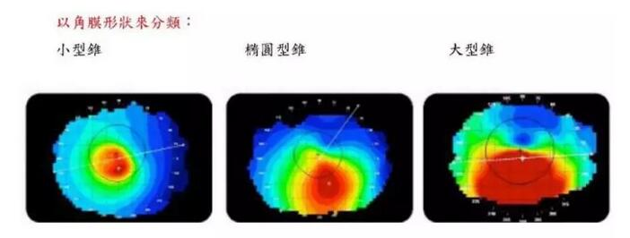 圆锥角膜是一种角膜扩张性疾病，患病后角膜中央或偏中央区域会发生局部变薄向外扩张，导致散光，并随着病情进展逐渐出现视力下降、 不良、视物扭曲变形、虹视等，极大影响生活，严重者可致盲。2.jpg