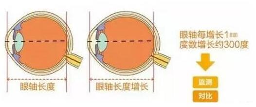 目前主流的摘镜方式有飞秒激光、准分子激光手术、ICL晶体植入术等近视手术方式，不论是高度近视、超高度近视、角膜偏薄患者、干眼患者， 检查合格，都有相应的近视手术 方案。.jpg