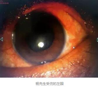 白内障和青光眼都是致盲性眼病，其中青光眼的病程不逆转。杨先生拖延伤情导致同时并发白内障、青光眼的情况，十分令人惋惜。”出名眼科专家、成都8868在线官网登录平台 - 8868网页版登录陈晓明教授表示2.jpg