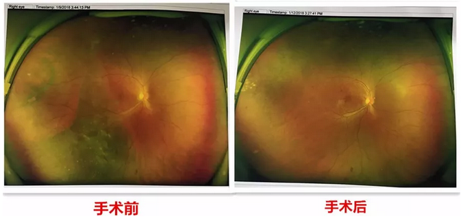 去年小李怀孕时，视力明显下降，甚至影响到了正常生活，这时已从怀孕初期的喜悦中冷静下来的小李，找到了福州眼科医院进行了一*次眼部检查。2.png