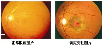 黄斑位于人眼底视网膜的中央，是视力 敏锐的部位，一般医生在测视力时，就是在检查黄斑区的视觉能力。当黄斑区出现异常时，也就是黄斑病变，人的中心视力就会变模糊、变扭曲。.png