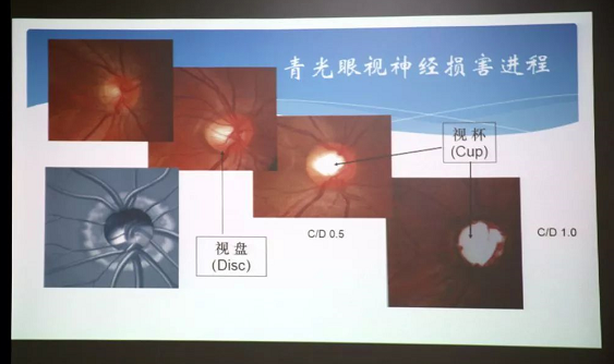 3月10日上午，深圳8868在线官网登录平台 - 8868网页版登录“早查监控，守护光明”大型青光眼公益科普讲座在六楼 举行，本次活动旨在让更多人了解青光眼的潜在危害、重视眼检查， 预防青光眼。由深圳8868在线官网登录平台 - 8868网页版登录青光眼病科 席专家成洪波博士、傅培副院长现场面对面解答疑问，与参会者的互动交流，让更多深圳市民提*对青光眼的认识与防治知识3.png