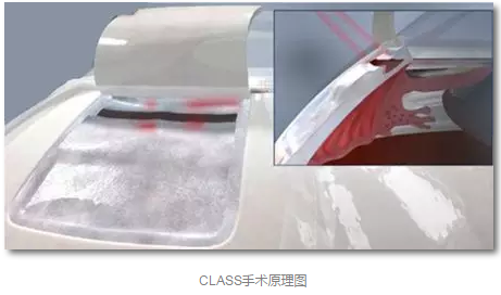 成都8868在线官网登录平台 - 8868网页版登录已经开展的青光眼手术有：引流阀 (钉)植入手术(2015年以来已200多 )，360°Schlemm's管切开术，激光CO2 辅助巩膜深层切除术，小梁切除术青(光眼)白(内障)联合手术。还有虹膜周切术、前房成形术、 虹膜复位术，睫状体冷冻术，小梁切开术和前房穿刺术等4.png