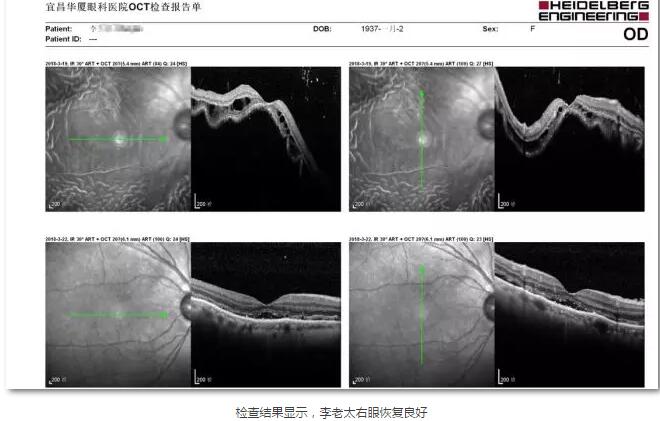 李老太在毫无征兆的情况下右眼视力下降至看不见东西。李老太家人带其至县医院就诊。医生诊断为视网膜脱离，需做玻切手术医治，而玻切手术需要动手术2次。怕疼的李老太一听就犯怵了：开刀，疼。 终，李老太的家人在多方打听后决定带李老太至宜昌8868在线官网登录平台 - 8868网页版登录找许大玲院长医治4.jpg
