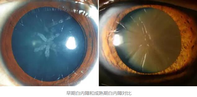 白内障超声乳化术是如今新式微创白内障手术，它创伤小、愈合快，术后 二天 正常生活。老年人能不能承受得住白内障手术呢2.jpg