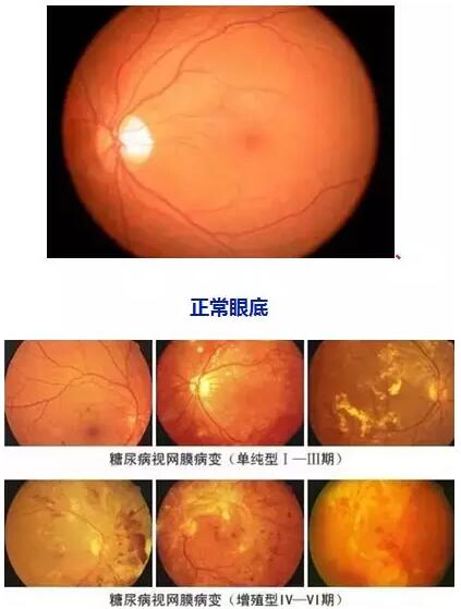 4月14日(本周六)福州眼科医院将举办“常见老年人眼底病”公益讲座，由医院副院长、眼底病科何建忠主任主讲，为大家解读各类眼底疾病的预防和诊治知识1.jpg
