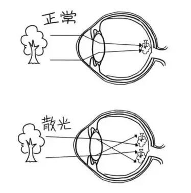 近视加散光想要 ，飞秒全激光近视手术是很好的选择。 一*次近视激光手术，就可以同时 近视、合并散光。1.jpg