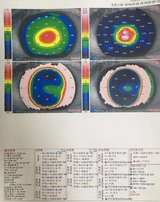角膜移植是利用异体的正常透明角膜组织，取代浑浊病变的角膜组织，使患者复明或控制角膜病变，这在目前同种器官移植当中， 率是 高的，也是重要的复明手术之一。”在 为一位饱受圆锥角膜之苦患者 实施角膜移植之后，卢敏院长也对患者极为关心的角膜移植相关知识进行介绍。比如哪些患者适合角膜移植手术