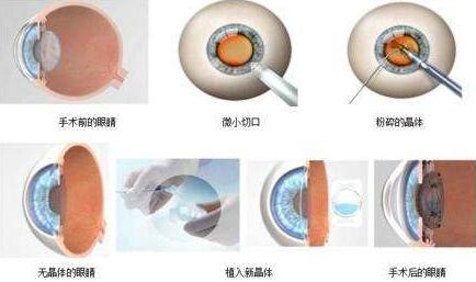 三焦点人工晶体手术原理：置换掉人眼老去的晶体，世代的晶体不仅有非常好的弹性，以往传统的白内障手术只是单纯的脱盲复明手术，更多的是解决患者 远视力。而三焦点人工晶体的问世，彻*解决了传统白内障术后仍需配镜的问题，实现了从以往‘看得见’到‘看得清、看得好’的转变.jpg