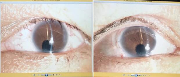 先天性虹膜脉络膜缺损的白内障患者在厦门眼科中心白内障超乳手术后视觉满意2.jpg