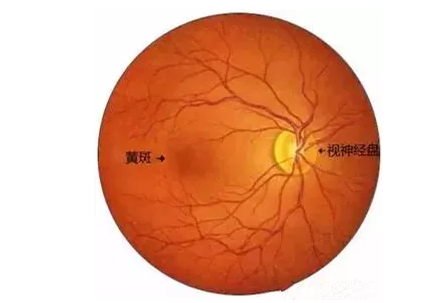 老年黄斑变性其实是眼部黄斑区结构的衰老性改变引起的眼病。“黄斑”是位于视网膜核心区的一个生理结构，一旦黄斑区的视神经细胞被破坏，就会引起患者中心视力下降、视物变形、色暗等1.png