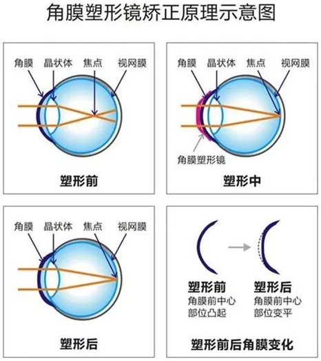 角膜塑形镜是一种硬性透气性隐形眼镜，戴在眼表可使角膜发生塑形效应，从而达到 近视度数的 。适合夜晚睡觉时配戴，白天不用戴眼镜就可以 裸眼视力，不影响学习、运动.png