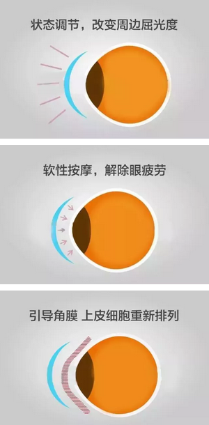 角膜塑形镜是一种硬性透气性隐形眼镜，戴在眼表可使角膜发生塑形效应，从而达到 近视度数的 。适合夜晚睡觉时配戴，白天不用戴眼镜就可以 裸眼视力，不影响学习、运动2.png