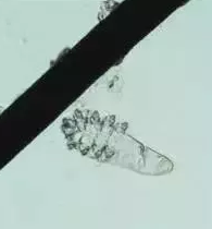 眼部瘙痒、干涩泛红、异物感，可能不是干眼症而是蠕形螨性睑缘炎.png