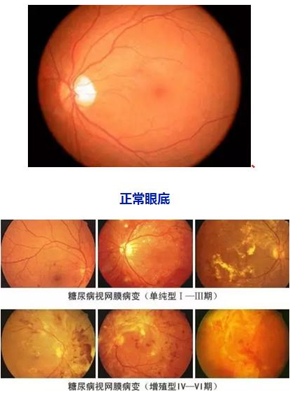 糖网病的症状和防治方式.png