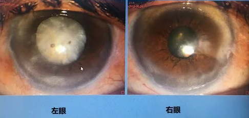 同时患 青光眼、白内障老婆婆辗转几家医院之后终于在成都8868登录平台顺利手术2.png