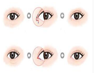 倒睫