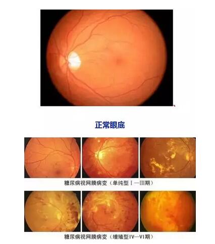 因糖网病几近失明在福州眼科医院进行微创玻切、白内障超乳术后顺利复明2.jpg