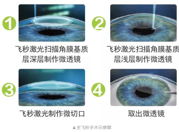 主流近视手术包含全飞秒激光手术、Smart全激光手术、半飞秒激光手术、晶体植入手术1.jpg