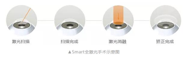 主流近视手术包含全飞秒激光手术、Smart全激光手术、半飞秒激光手术、晶体植入手术2.jpg