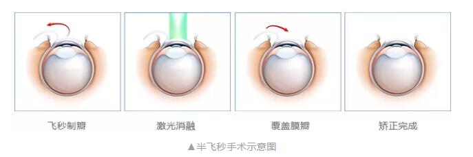 主流近视手术包含全飞秒激光手术、Smart全激光手术、半飞秒激光手术、晶体植入手术3.jpg