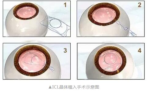 主流近视手术包含全飞秒激光手术、Smart全激光手术、半飞秒激光手术、晶体植入手术4.jpg