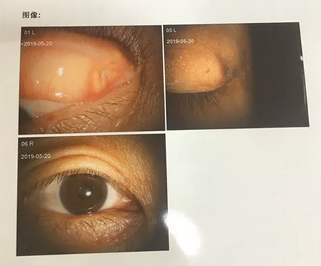 成都8868登录平台罗清礼院长为四处求医未果的河南眼眶肿瘤患者手术2.png