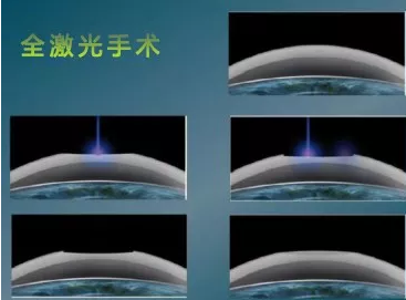 全国高考成绩分数线陆续出来了安徽理工大学附属眼科医院近视手术医生温馨提醒近视考生要注意这些1.png