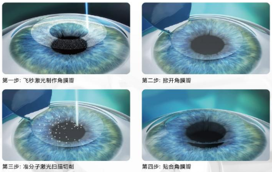 近视无法根治？但你可以这样做？8868登录平台“有爱就有希望”近视手术火热进行中5.png