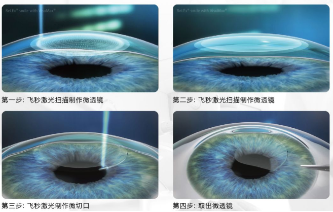 近视无法根治？但你可以这样做？8868登录平台“有爱就有希望”近视手术火热进行中6.png