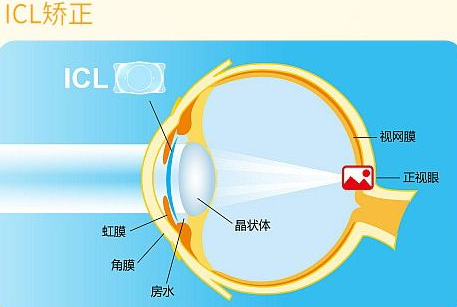 近视无法根治？但你可以这样做？8868登录平台“有爱就有希望”近视手术火热进行中8.png