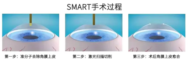 高考毕业后做近视手术，如今近视手术有了越来越高的安全性，且多样的术式可以满足不同患者的摘镜需求。2.png