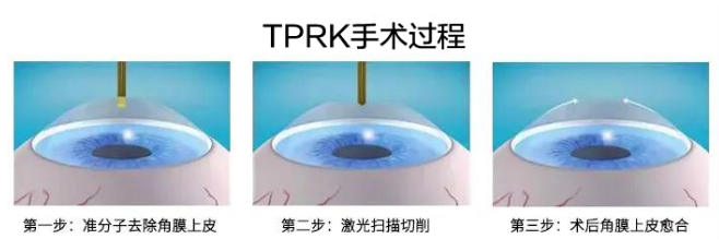 2021年征兵时间已定，参加征兵近视青年需尽快做近视手术3.png